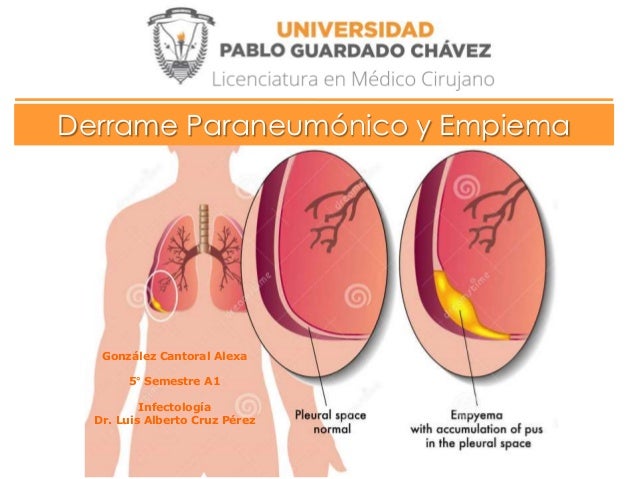 derrame paraneumonico y empiema